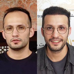 مرکز کاشت مو هیرادکاشت کاشت مو ابرو ریش در پاسداران 3 1