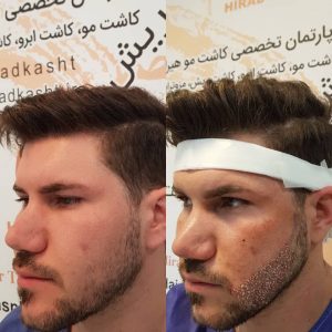 مرکز کاشت مو هیرادکاشت کاشت مو ابرو ریش در پاسداران 5 1