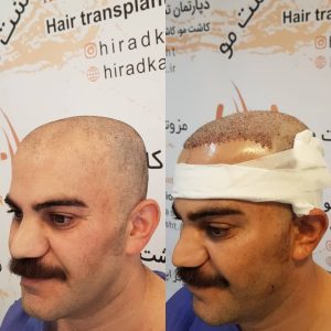 مرکز کاشت مو هیرادکاشت کاشت مو ابرو ریش در پاسداران 6 1