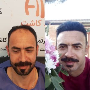 مرکز کاشت مو هیرادکاشت کاشت مو ابرو ریش در پاسداران 7 1