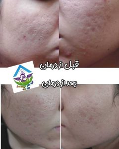 کلبه جادو طبیعت سبز خدمات تخصصی رفع جوش و لک و اسکالپ در قم گلزار شهدا 19