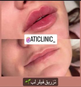 زیبایی آتی پاکسازی فشیال میکرو تهران جنت آبادجنوبی کوچه نوری 2
