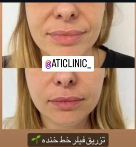 زیبایی آتی پاکسازی فشیال میکرو تهران جنت آبادجنوبی کوچه نوری 4 1