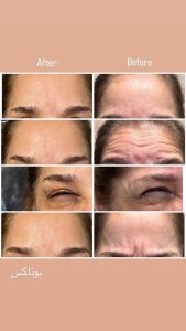 کلینیک روشا لیزر ژل بوتاکس هایفوتراپی در نارمک جنوبی