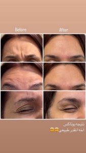 کلینیک روشا لیزر ژل بوتاکس هایفوتراپی در نارمک جنوبی