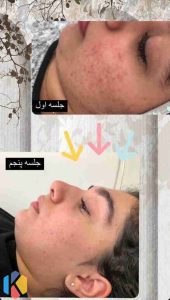 ‏سالن ‏زیبایی ‏مرکاتو ‏فیشال ‏پاکسازی ‏پوست ‏اسیدتراپی ‏در ‏شمس ‏آباد ‏هروی 9 2
