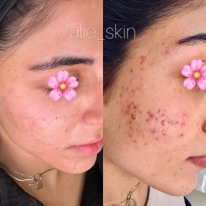 پهلوان پور خدمات و آموزش پاکسازی صورت و فشیال و مراقبت های پوستی در کرج مهر ویلا 20