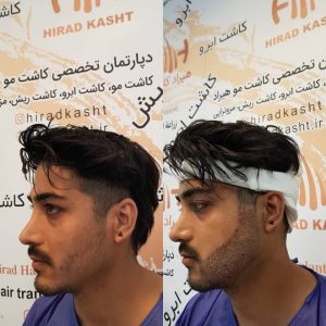 مرکز کاشت مو هیرادکاشت کاشت مو ابرو ریش در پاسداران 11