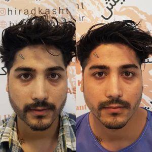 مرکز کاشت مو هیرادکاشت کاشت مو ابرو ریش در پاسداران 4