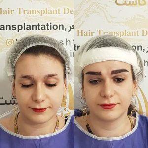 مرکز کاشت مو هیرادکاشت کاشت مو ابرو ریش در پاسداران 9