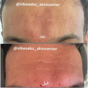 مرکز ‏پوست ‏و ‏مو ‏و ‏زیبایی ‏سیب ‏سبز ‏کربوکسی ‏تراپی ‏فیشال ‏جوانسازی ‏بوتاکس ‏در ‏قزوین ‏خیابان ‏دانشگاه