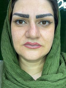 دکتر دهقان تزریق ژل بوتاکس لیزر موهای زائد تاتو و لک در ملارد مارلیک 1 2