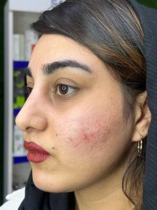 کلینیک دکتر دهقان تزریق ژل بوتاکس لیزر موهای زائد تاتو و لک در ملارد مارلیک 2