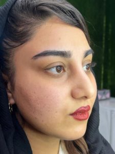 کلینیک دکتر دهقان تزریق ژل بوتاکس لیزر موهای زائد تاتو و لک در ملارد مارلیک 5