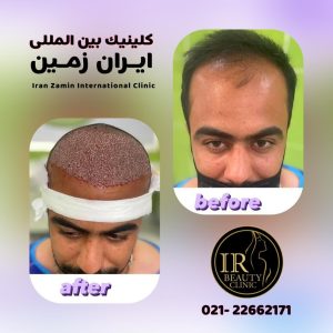 کلینیک زیبایی ایران زمین کاشت مو تخصصی آقایان کاشت ابرو بانوان در الهیه 10