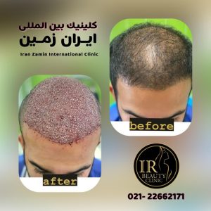 کلینیک زیبایی ایران زمین کاشت مو تخصصی آقایان کاشت ابرو بانوان در الهیه 3