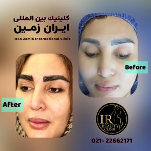 کلینیک زیبایی ایران زمین کاشت مو تخصصی آقایان کاشت ابرو بانوان در الهیه 4
