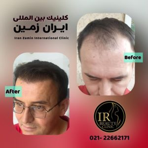 کلینیک زیبایی ایران زمین کاشت مو تخصصی آقایان کاشت ابرو بانوان در الهیه 8