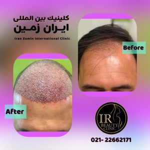 کلینیک زیبایی ایران زمین کاشت مو تخصصی آقایان کاشت ابرو بانوان در الهیه 9