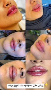 کلینیک ‏زیبایی ‏توکا ‏ژل ‏بوتاکس ‏و ‏هایفو ‏لیزر ‏در ‏نازی ‏آباد 2