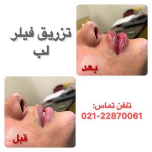 کلینیک ‏زیبایی ‏ماه ‏طلایی ‏بوتاکس ‏پیشانی ‏و ‏ژل ‏لب ‏در تهران ‏شریعتی
