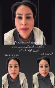 بیوتی لند تزریق چربی ژل بوتاکس لیزر موهای زائد تخلیه چربی در تهران پاسداران 6 3 1 1 1 1