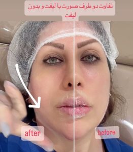 سحر بیوتی لند تزریق چربی ژل بوتاکس لیزر موهای زائد تخلیه چربی در تهران پاسداران 9 2 1 1
