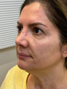مرکز السا خدمات لیزر و زیبایی و پاکسازی پوست در تهران تجریش 15