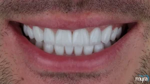 7 Benefits of Dental Veneers