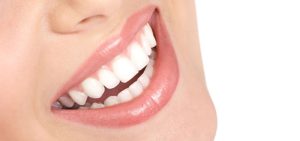 Laminate and closing of the space between the teeth