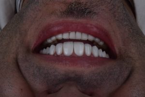 ‏شریف ‏دلربایی ‏کامپوزیت ‏لمینت ‏جراحی ‏فک ‏و ‏صورت ‏‏درمشهد خیام 2