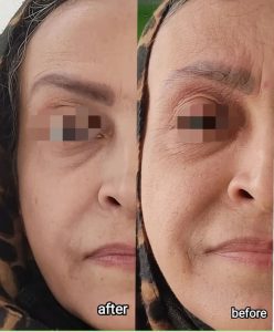 ‏فهیمه ‏درفشی ‏خدمات ‏هایفوتراپی ‏‏لیفت ‏نخ ‏اندولیفت ‏در ‏تهران میرداماد 8