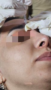 کلینیک ‏ماری ‏خدمات ‏فشیال ‏مزوتراپی ‏مو ‏پروفایلو ‏در ‏تهران 3