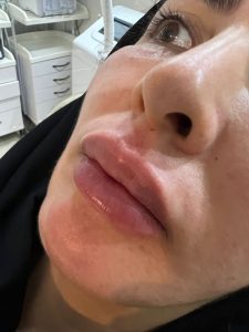 کلینیک ‏ماری ‏خدمات ‏فشیال ‏مزوتراپی ‏مو ‏پروفایلو ‏در ‏تهران 6