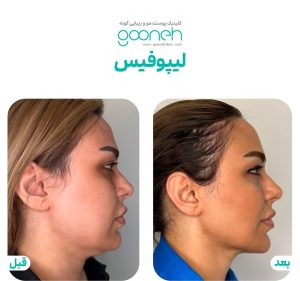 ‏کلینیک ‏گونه ‏بلفاروپلاستی ‏لیپوفیس ‏بوکال ‏فت ‏در ‏تهران ‏جردن 10