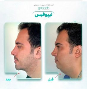 ‏کلینیک ‏گونه ‏بلفاروپلاستی ‏لیپوفیس ‏بوکال ‏فت ‏در ‏تهران ‏جردن 11