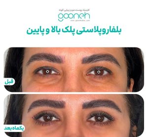 ‏کلینیک ‏گونه ‏بلفاروپلاستی ‏لیپوفیس ‏بوکال ‏فت ‏در ‏تهران ‏جردن 12