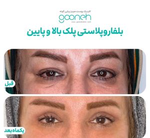 ‏کلینیک ‏گونه ‏بلفاروپلاستی ‏لیپوفیس ‏بوکال ‏فت ‏در ‏تهران ‏جردن 13