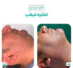 ‏کلینیک ‏گونه ‏بلفاروپلاستی ‏لیپوفیس ‏بوکال ‏فت ‏در ‏تهران ‏جردن 2
