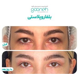 ‏کلینیک ‏گونه ‏بلفاروپلاستی ‏لیپوفیس ‏بوکال ‏فت ‏در ‏تهران ‏جردن 3