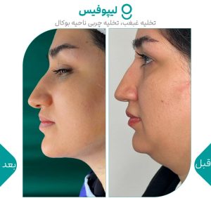 ‏کلینیک ‏گونه ‏بلفاروپلاستی ‏لیپوفیس ‏بوکال ‏فت ‏در ‏تهران ‏جردن
