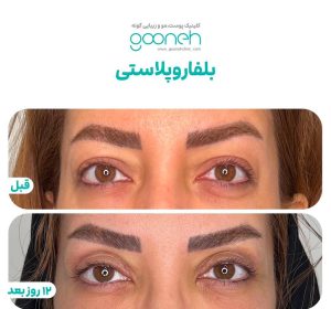 ‏کلینیک ‏گونه ‏بلفاروپلاستی ‏لیپوفیس ‏بوکال ‏فت ‏در ‏تهران ‏جردن 4