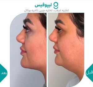 ‏کلینیک ‏گونه ‏بلفاروپلاستی ‏لیپوفیس ‏بوکال ‏فت ‏در ‏تهران ‏جردن 5