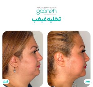 ‏کلینیک ‏گونه ‏بلفاروپلاستی ‏لیپوفیس ‏بوکال ‏فت ‏در ‏تهران ‏جردن 6