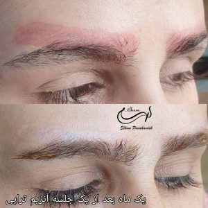 174390 رفع قرمزی بعد از ریموو min 1