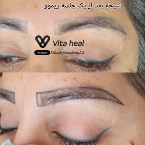 174392 ریموو تاتو کادر دار min