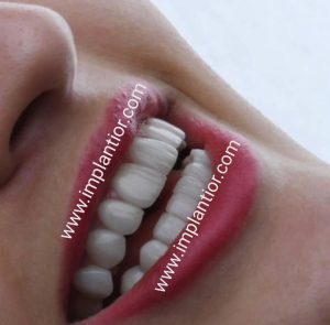 کلینیک ‏تخصصی ‏ایمپلنت ‏خدمات ‏روکش ‏دندان ‏درمان ‏ریشه ‏بلیچینگ ‏با ‏قیمت ‏مناسب ‏در ‏تهران ‏سعادت ‏آباد