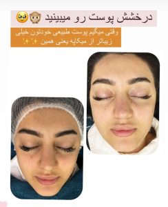 اکرم فارسیجانی فیشال پاکسازی جوانسازی پوست در عظیمیه کرج 4