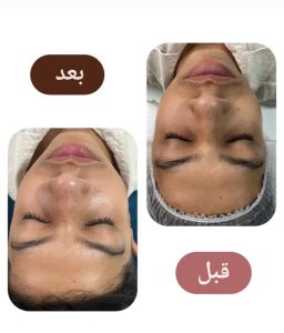 اکرم فارسیجانی فیشال پاکسازی جوانسازی پوست در عظیمیه کرج 9