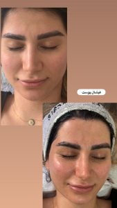 سالن زیبایی مرکاتو فیشال پاکسازی پوست اسیدتراپی در شمس آباد هروی